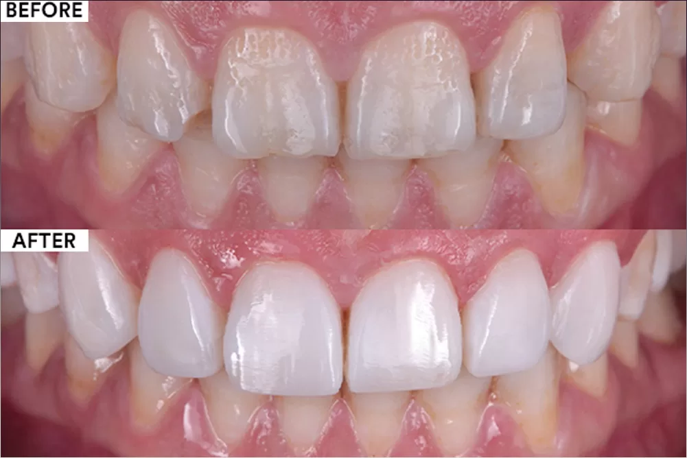 Dental Veneers Before & After